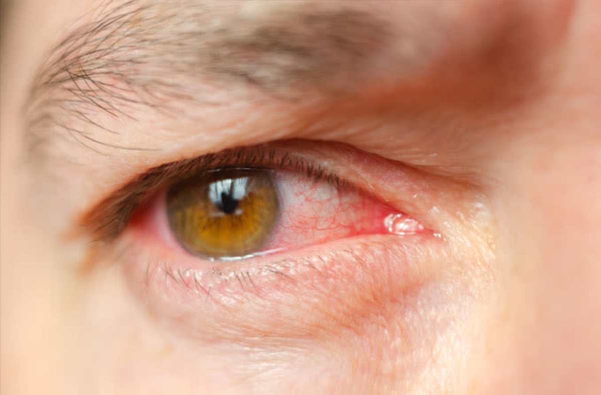 Infecciones en el ojo más frecuentes: